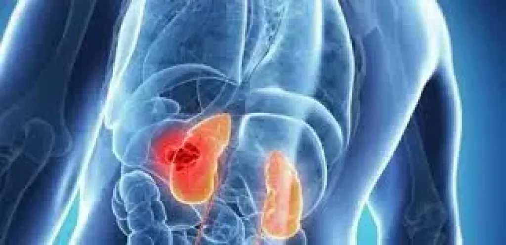 حصوات الكلى.