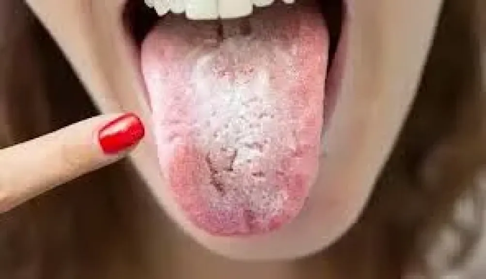 أعراض سرطان الفم