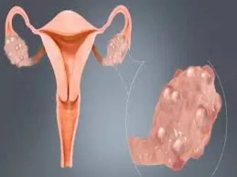 أنواع وأعراض تكيس المبايض